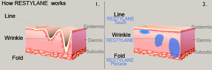 [how Restylane works?]