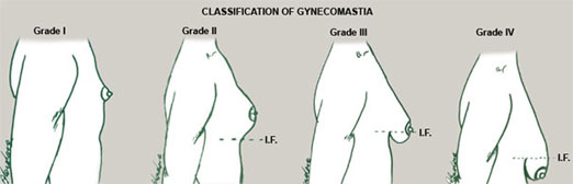[clasificarea ginecomastiei]