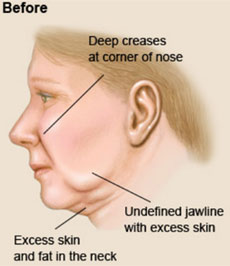 [lifting facial]