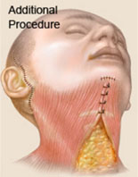[lifting facial]