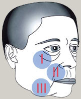 [lifting facial]