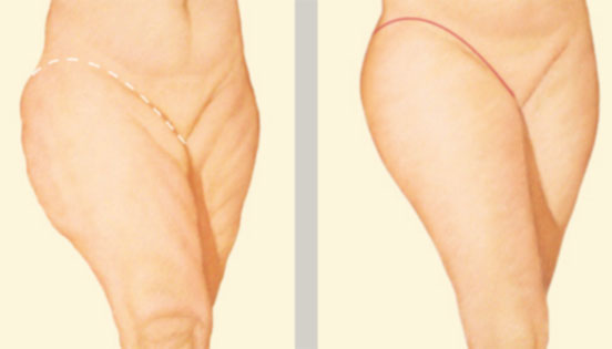 [exemplu body lift coapse: postoperatoriu si preoperatoriu]
