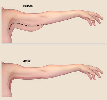 [lifting: brate; post-preoperatoriu]