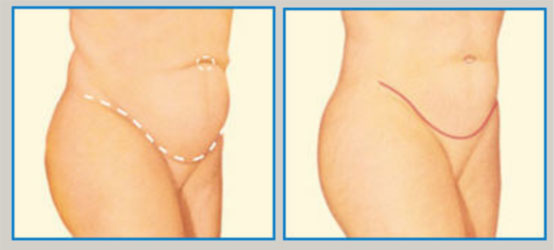 lifting: abdomen]