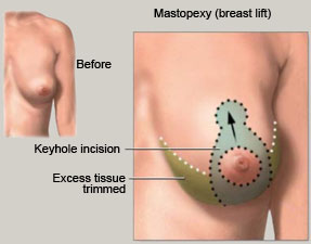 [mastopexy]