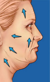 [lifting facial]