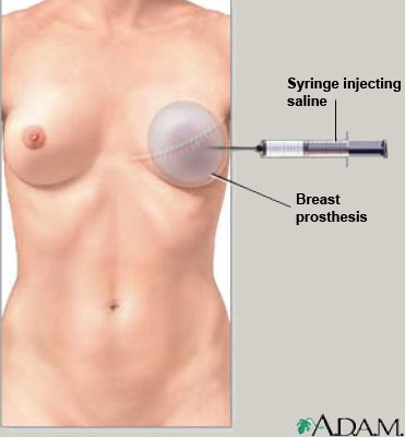 [Syringe injecting saline. Breast prothesis]