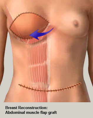 [Abdominal muscle flap graft]