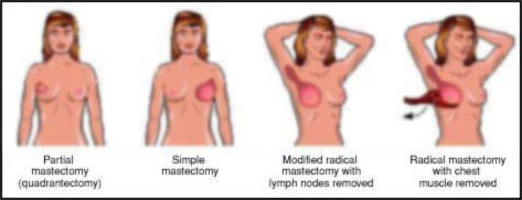 [Masectomy stages]